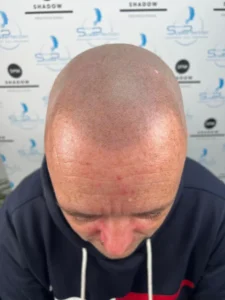 Rezultat micropigmentare scalp Constanța