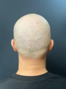 După — SMP Alopecie