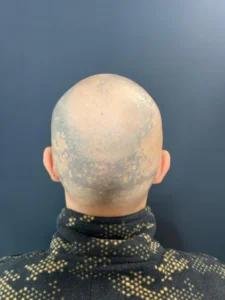 Înainte — SMP Alopecie