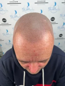 Rezultat micropigmentare chelie — ScalpMicroArt Constanța