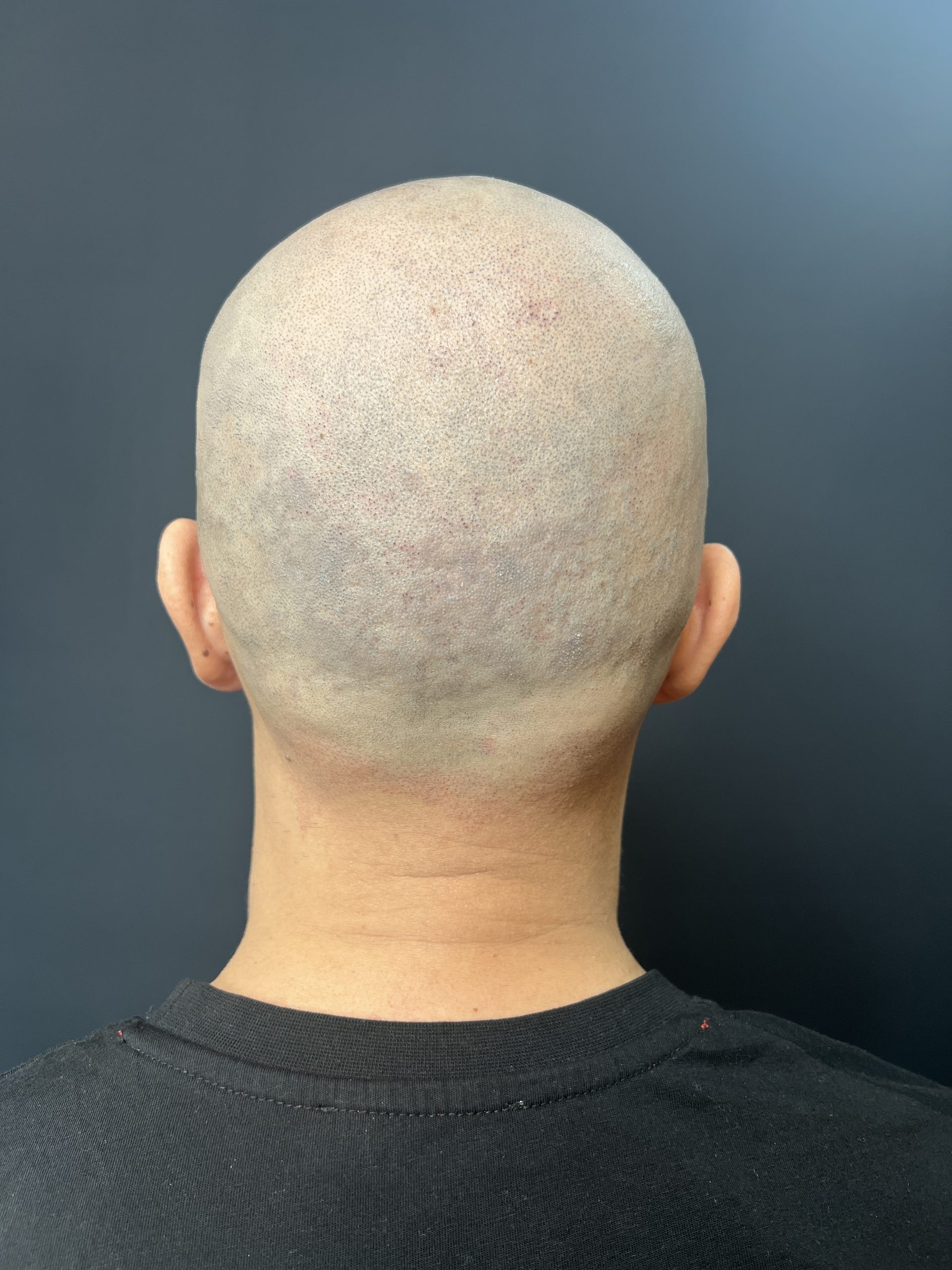 Alopecie areată după SMP Constanța