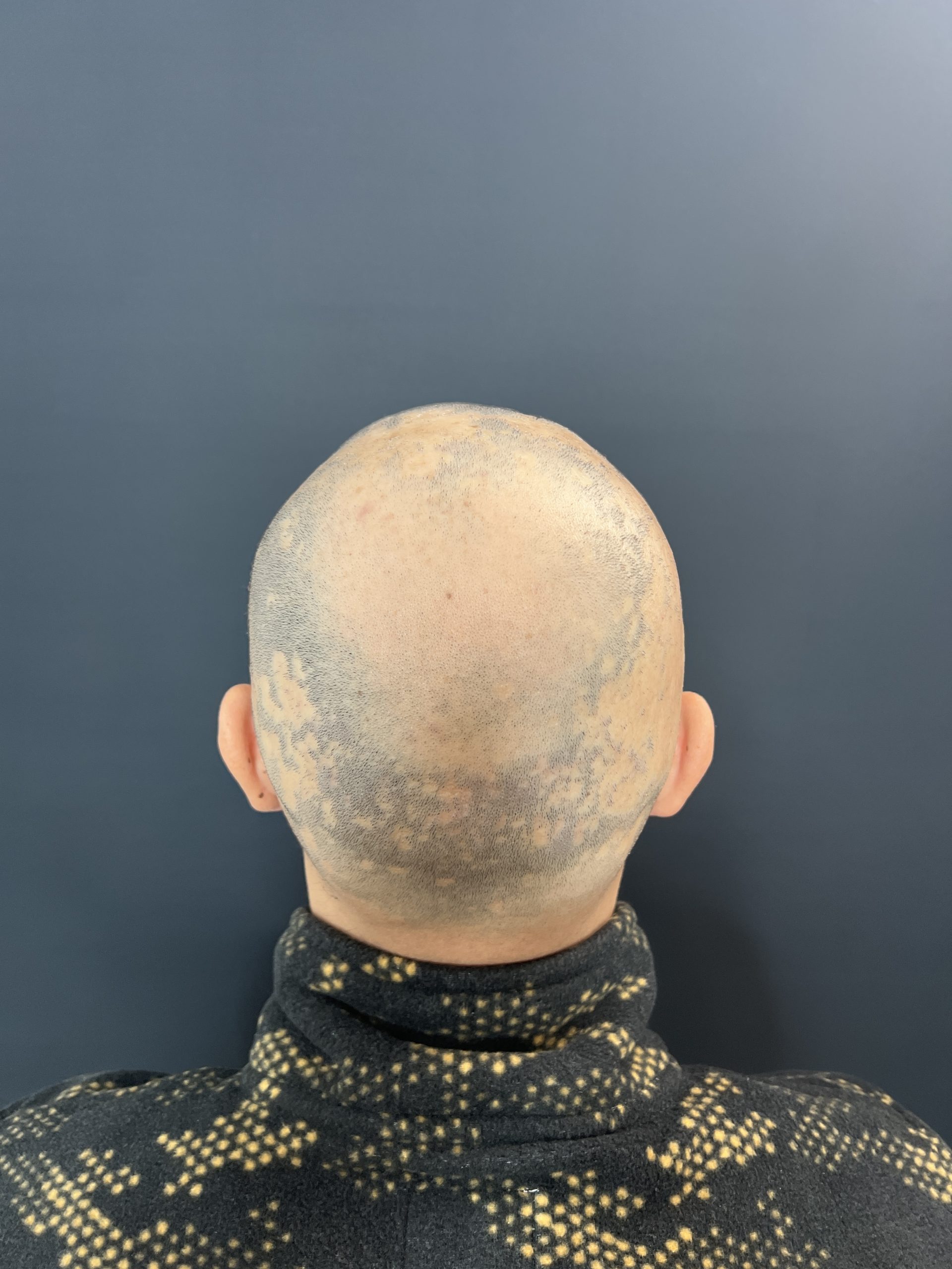 Alopecie areată înainte SMP Constanța