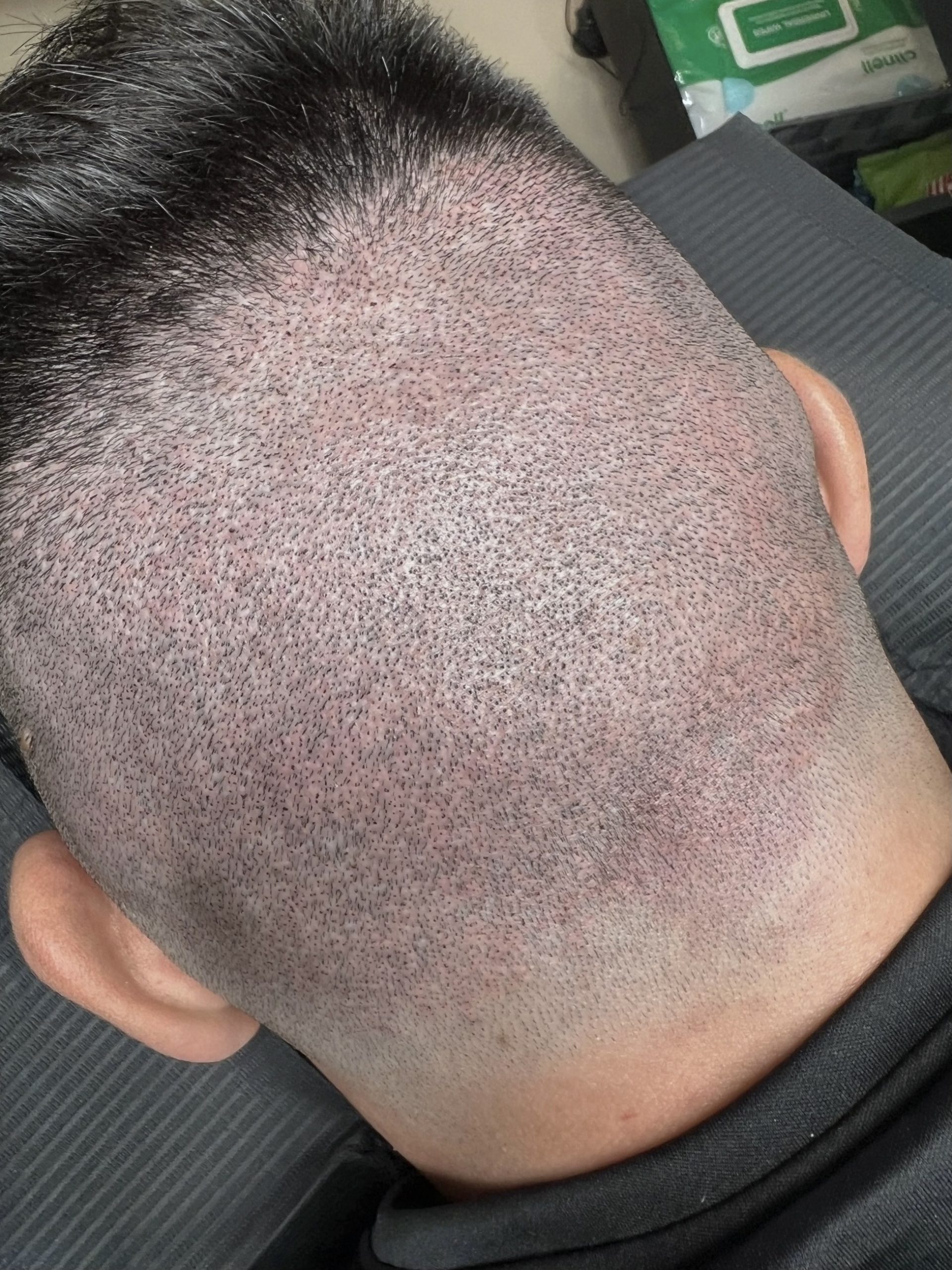 Rezultat micropigmentare scalp Constanța