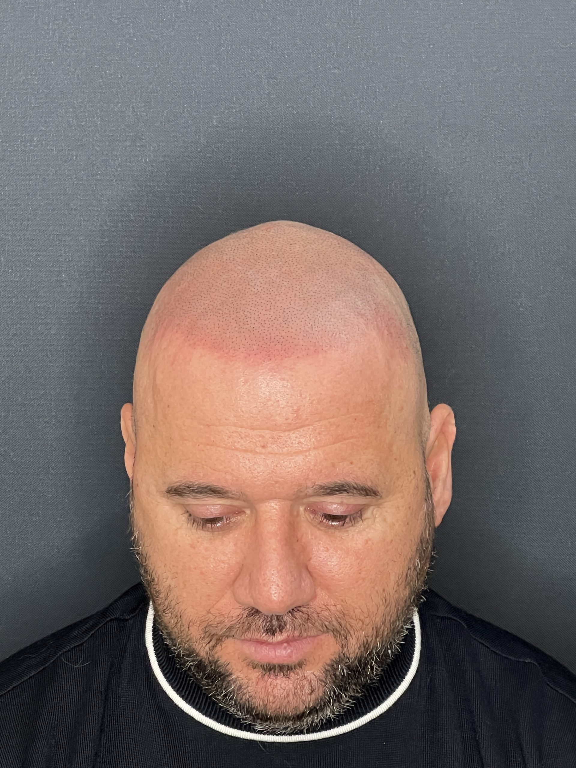 Chelie după micropigmentare scalp Constanța