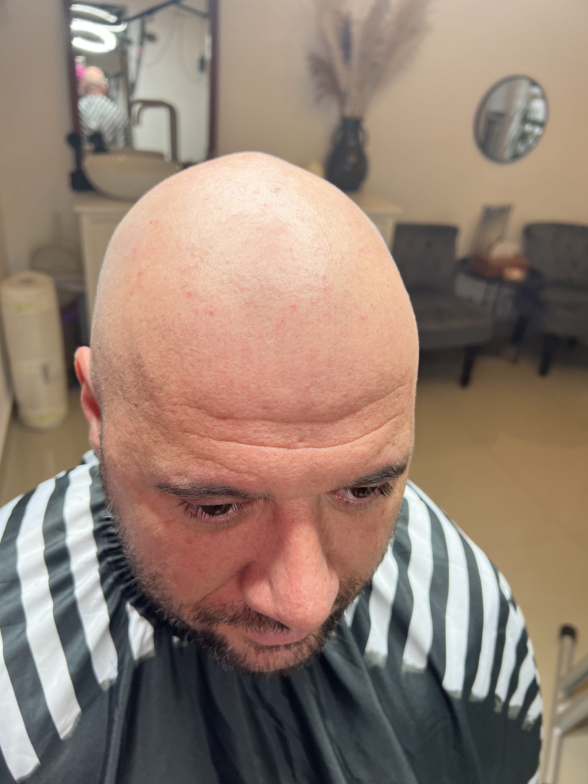 Chelie înainte micropigmentare scalp Constanța