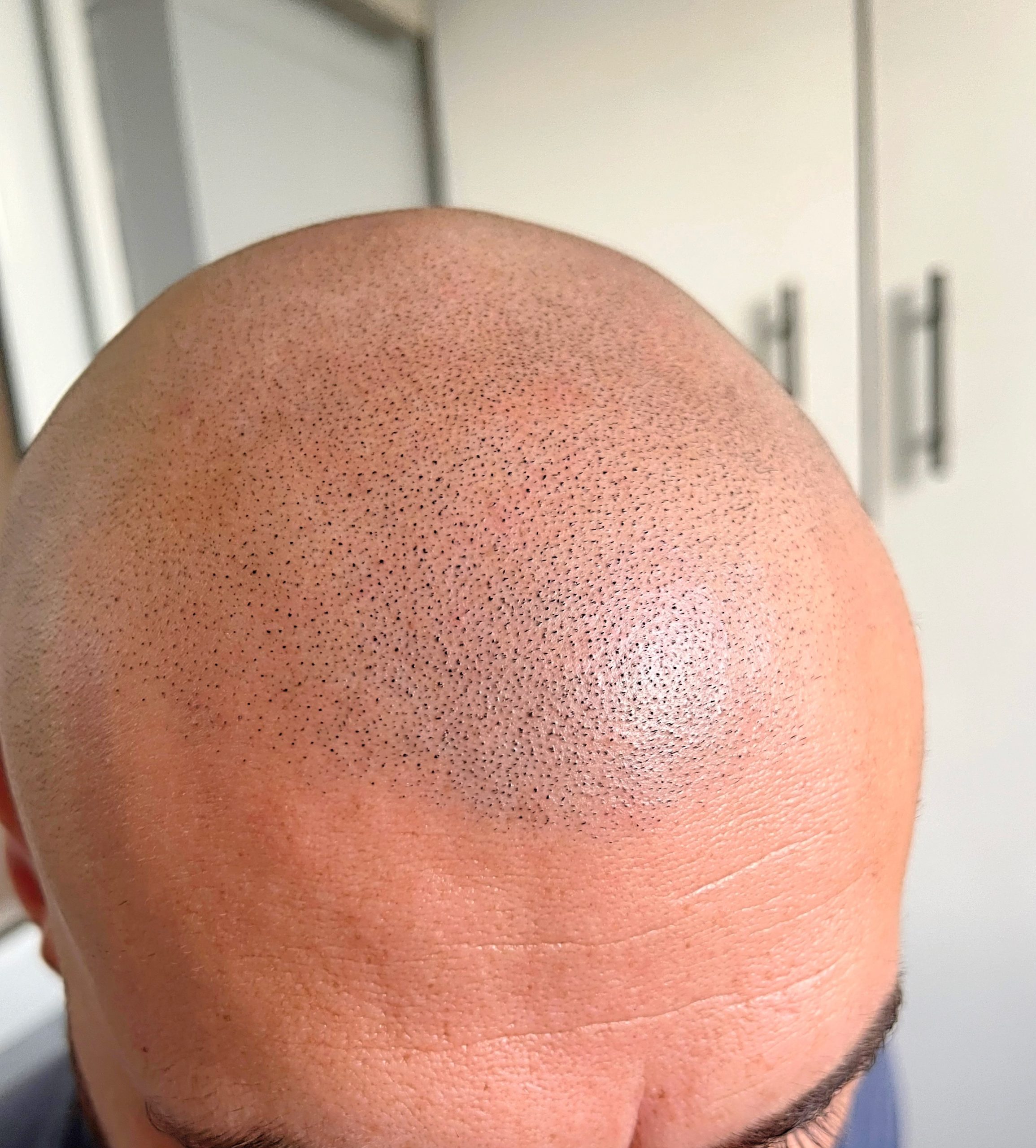 După micropigmentare chelie client Adrian — ScalpMicroArt Constanța