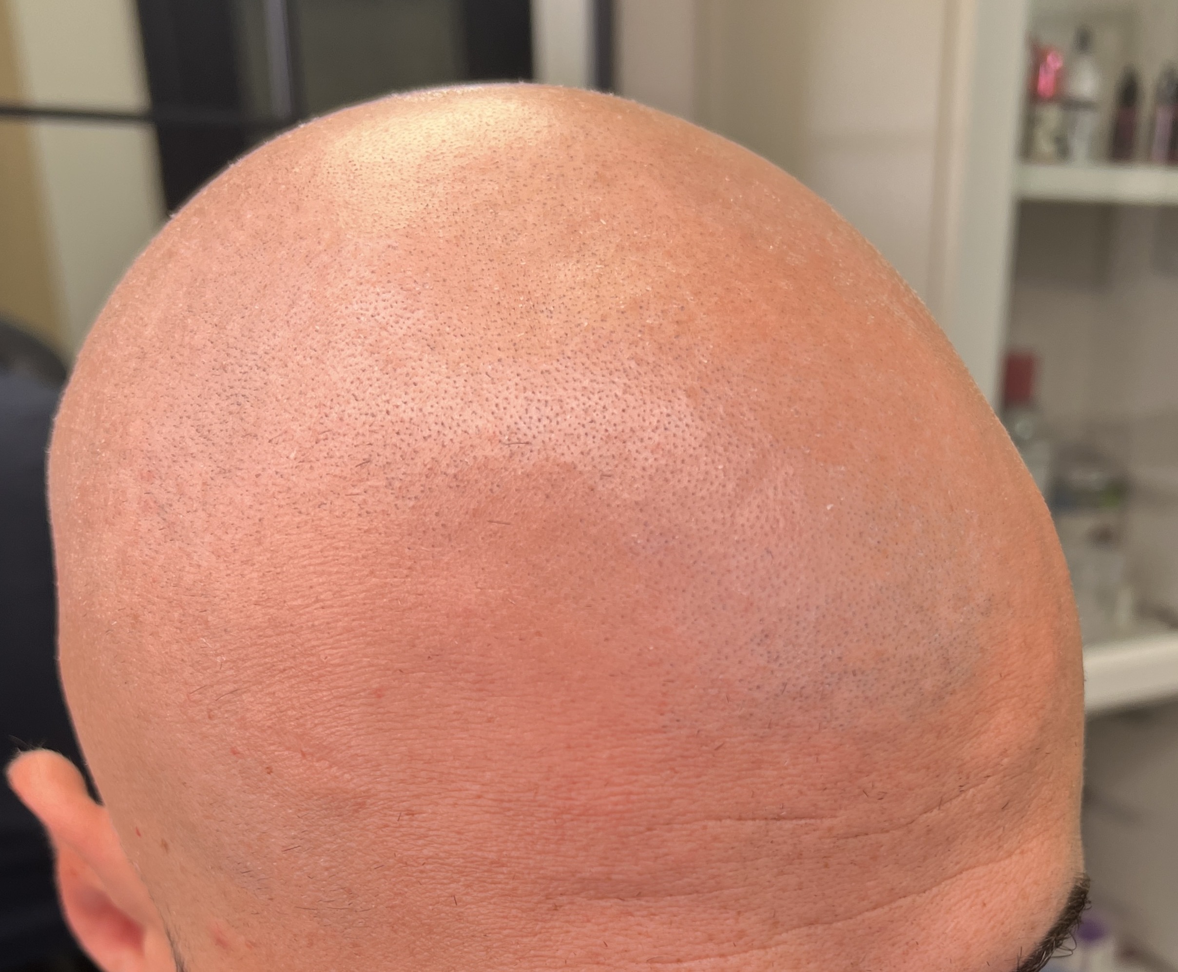 Înainte micropigmentare chelie client Adrian — ScalpMicroArt Constanța