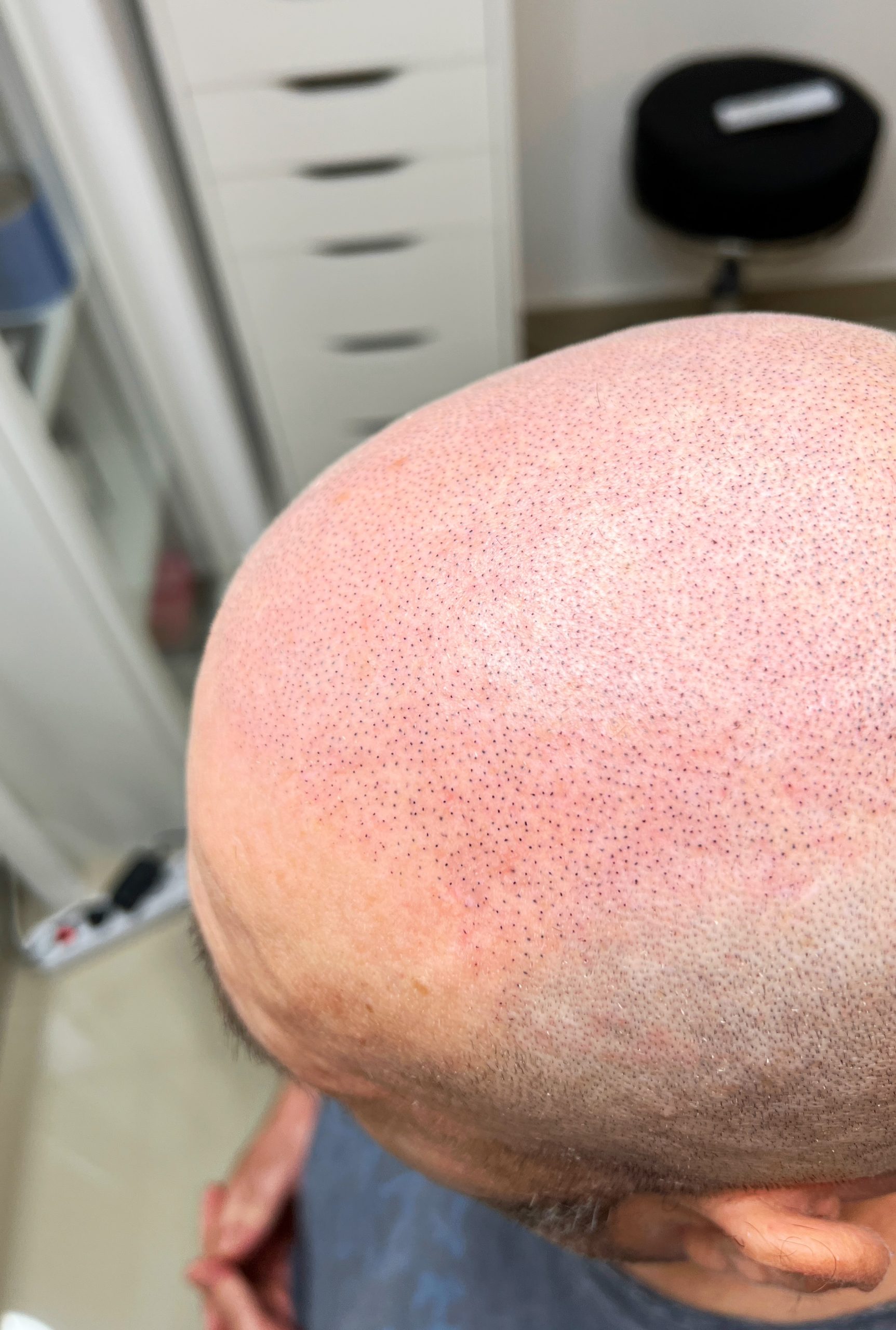 După micropigmentare chelie avansată — ScalpMicroArt Constanța