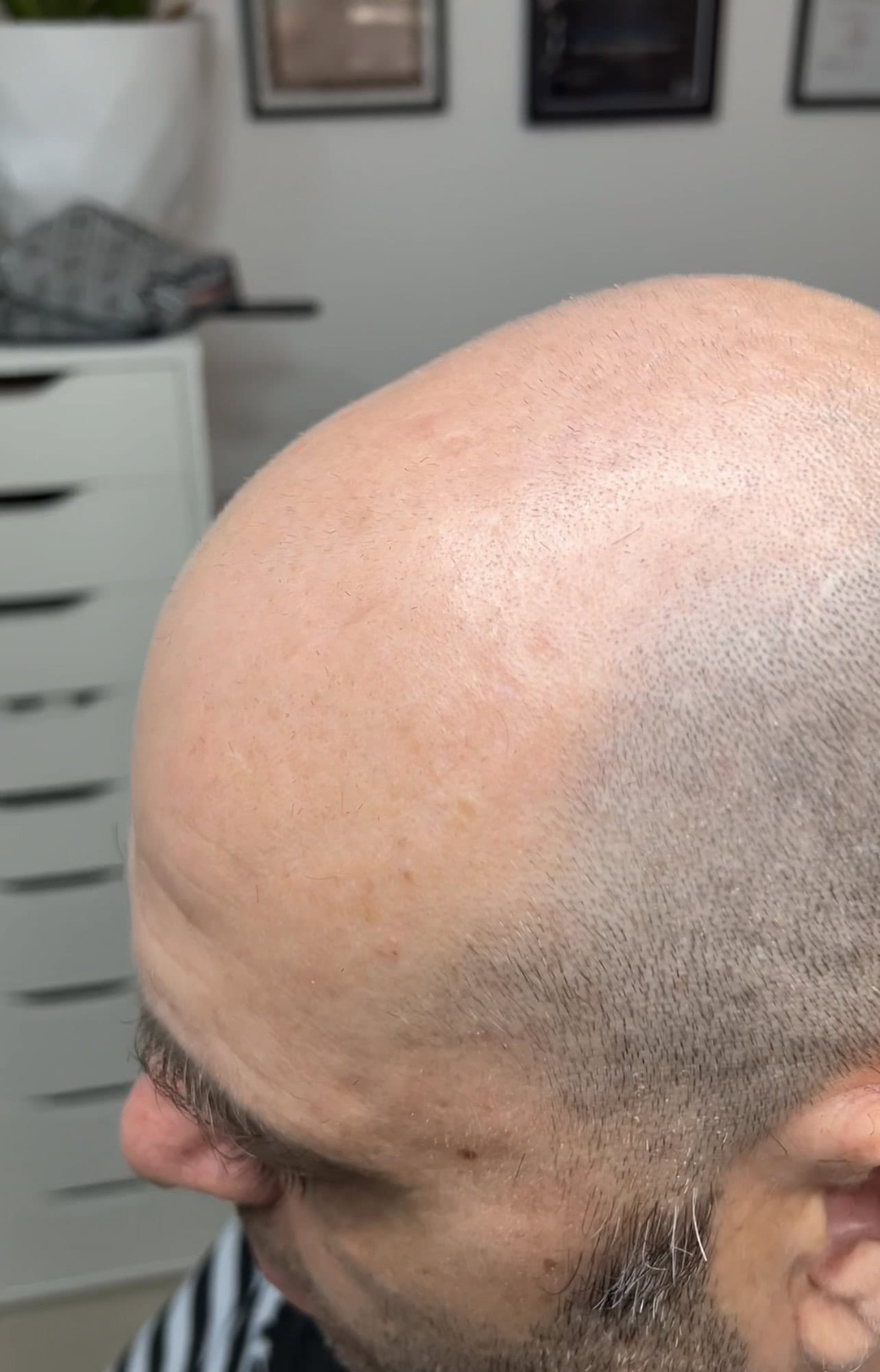 Înainte micropigmentare chelie avansată — ScalpMicroArt Constanța