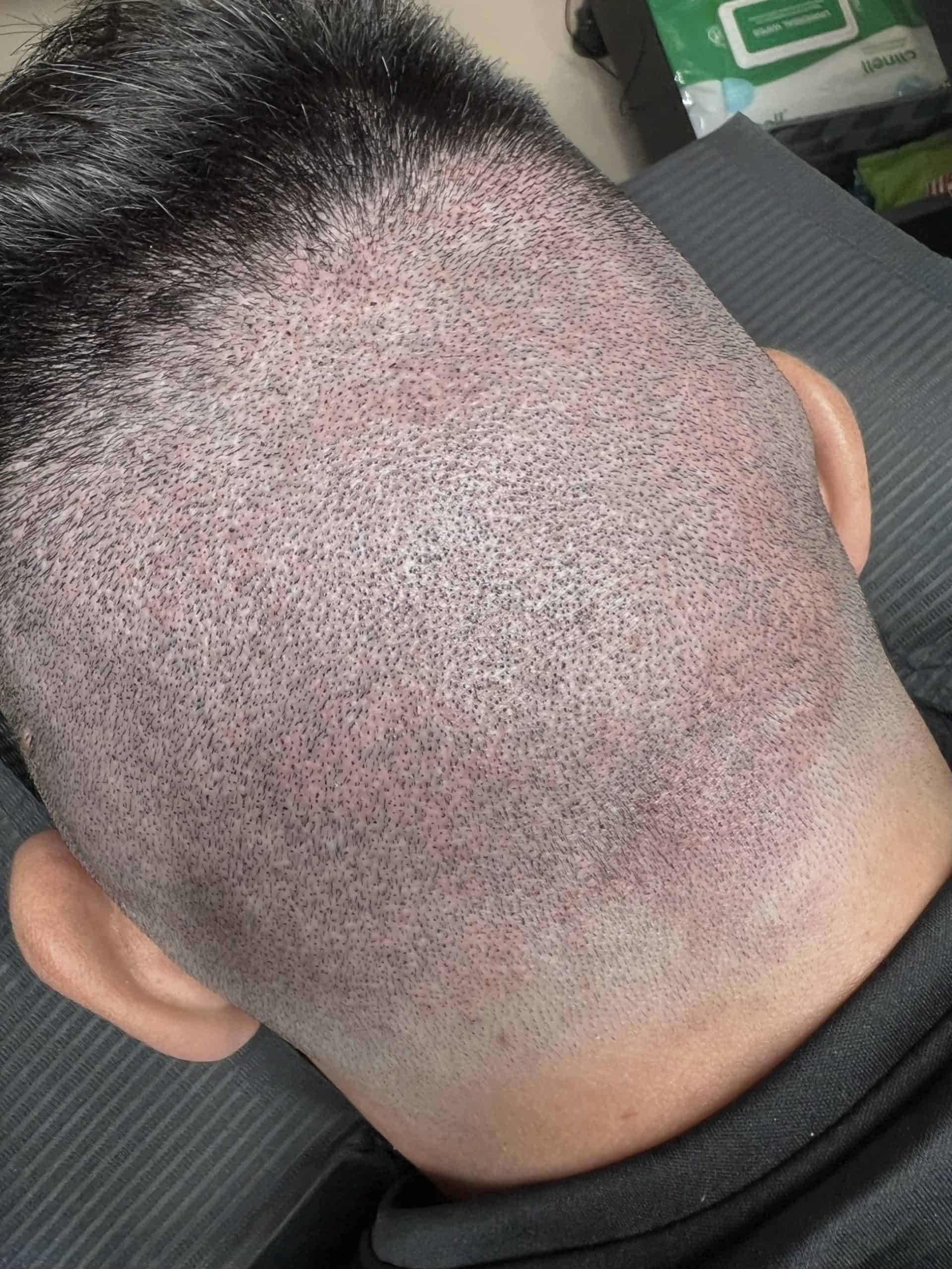 După camuflaj cicatrici transplant — ScalpMicroArt Constanța