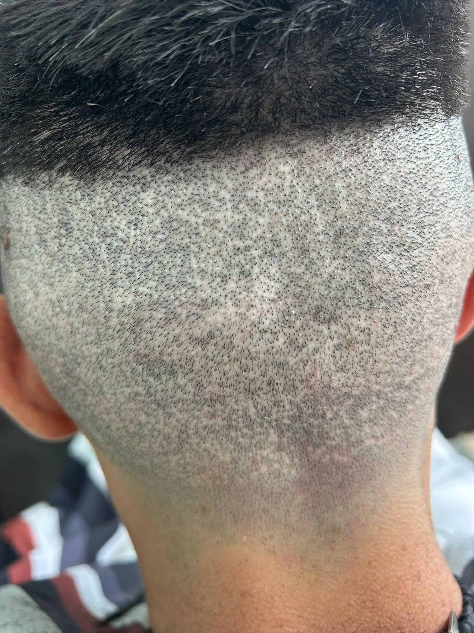 Înainte camuflaj cicatrici transplant — ScalpMicroArt Constanța