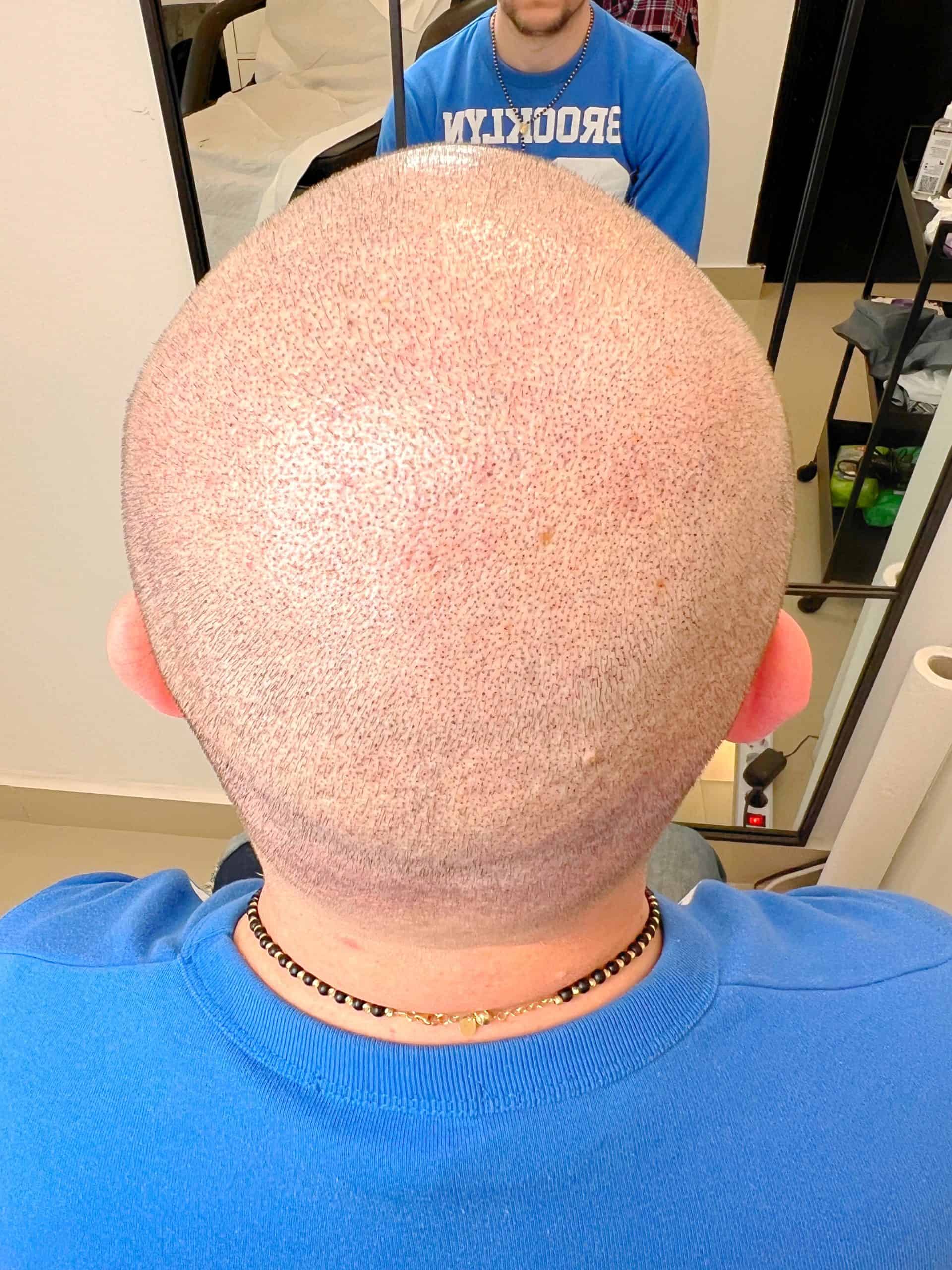 Cicatrici post-transplant după SMP Constanța