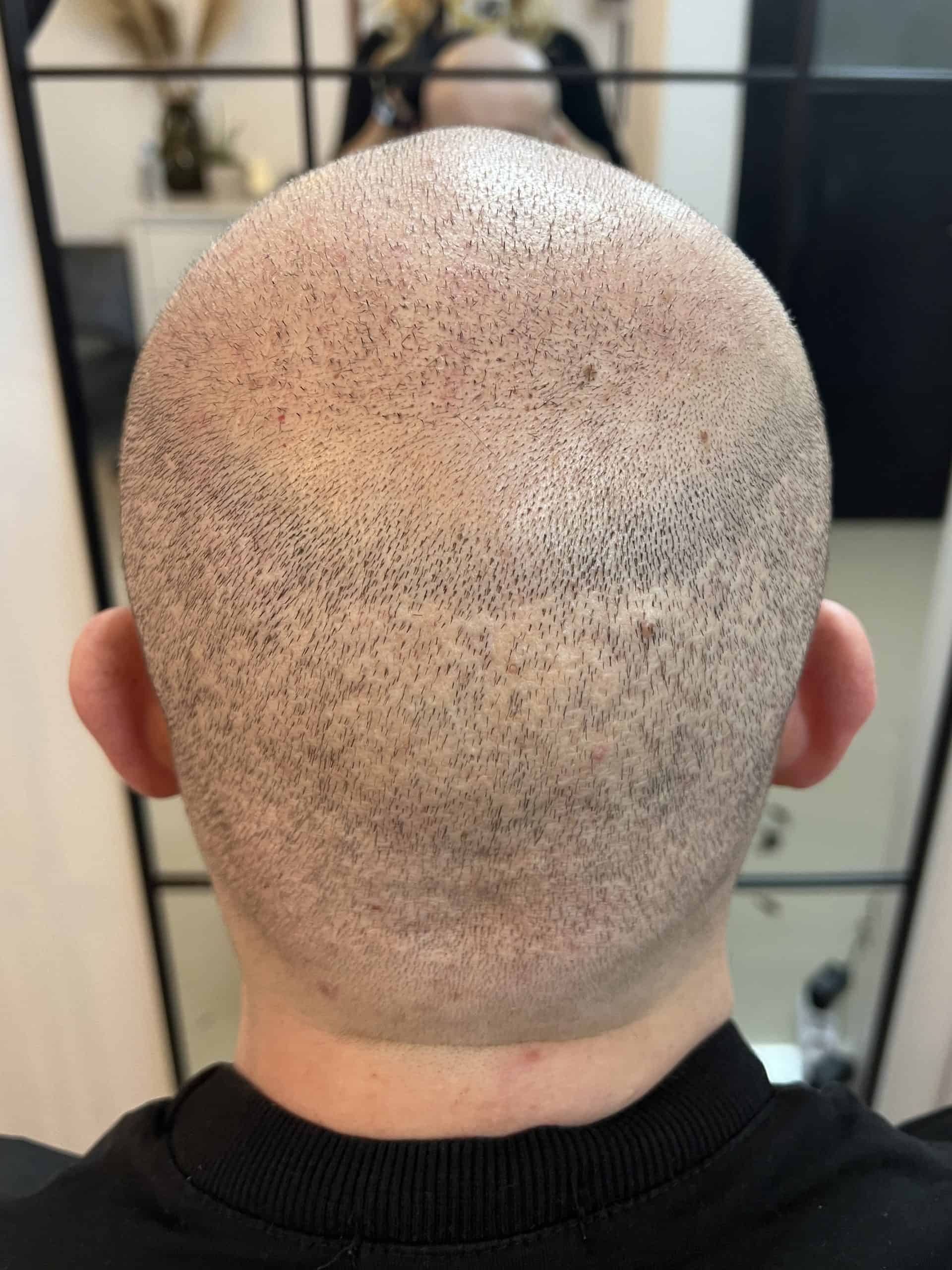 Cicatrici post-transplant înainte SMP Constanța