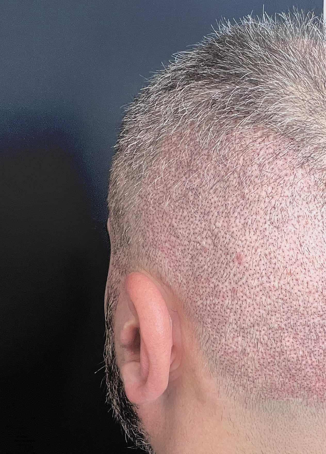 Chelie post-implant agresiv după SMP — ScalpMicroArt Constanța