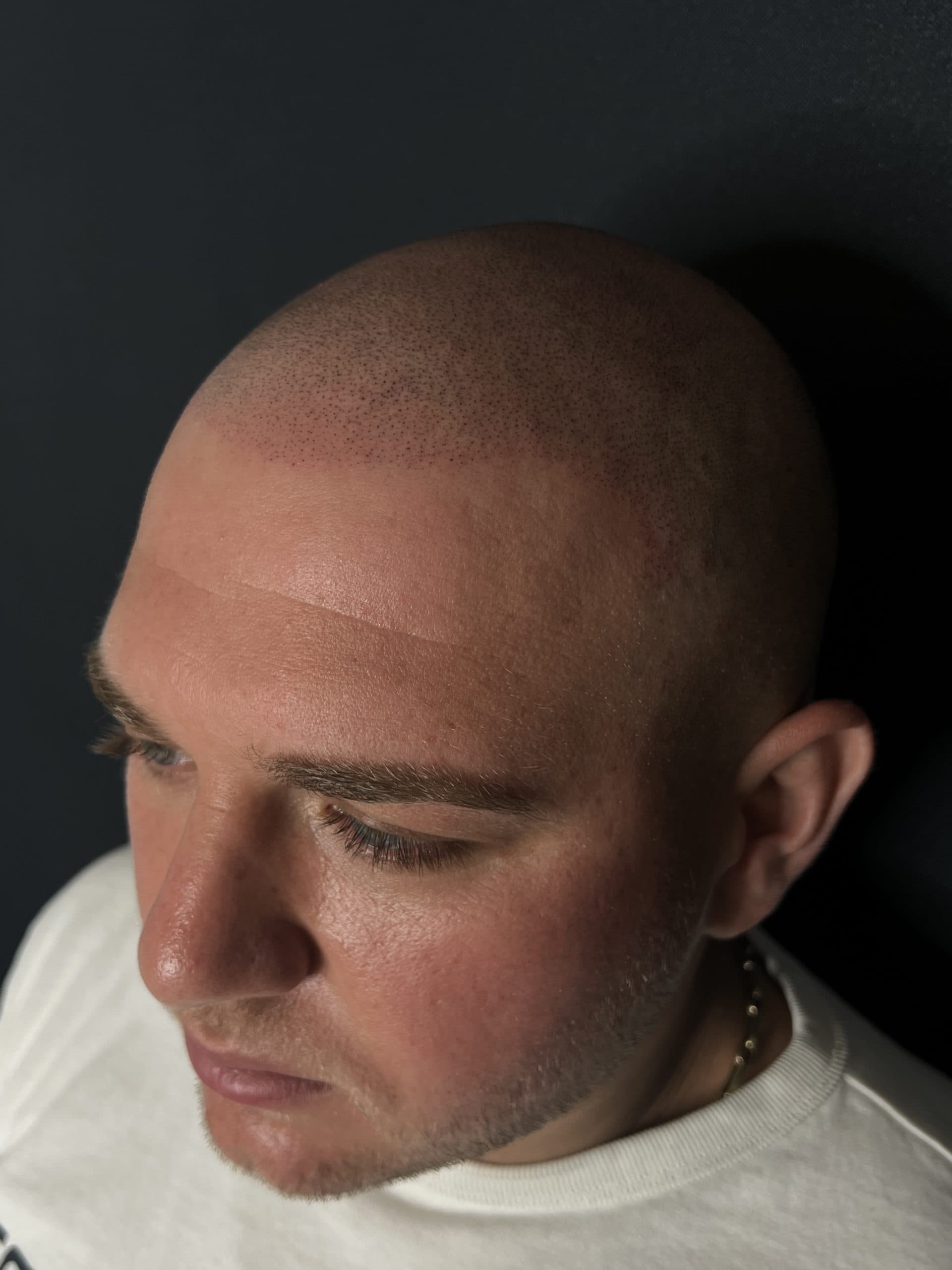 Chelie parțială frontală după SMP — ScalpMicroArt Constanța