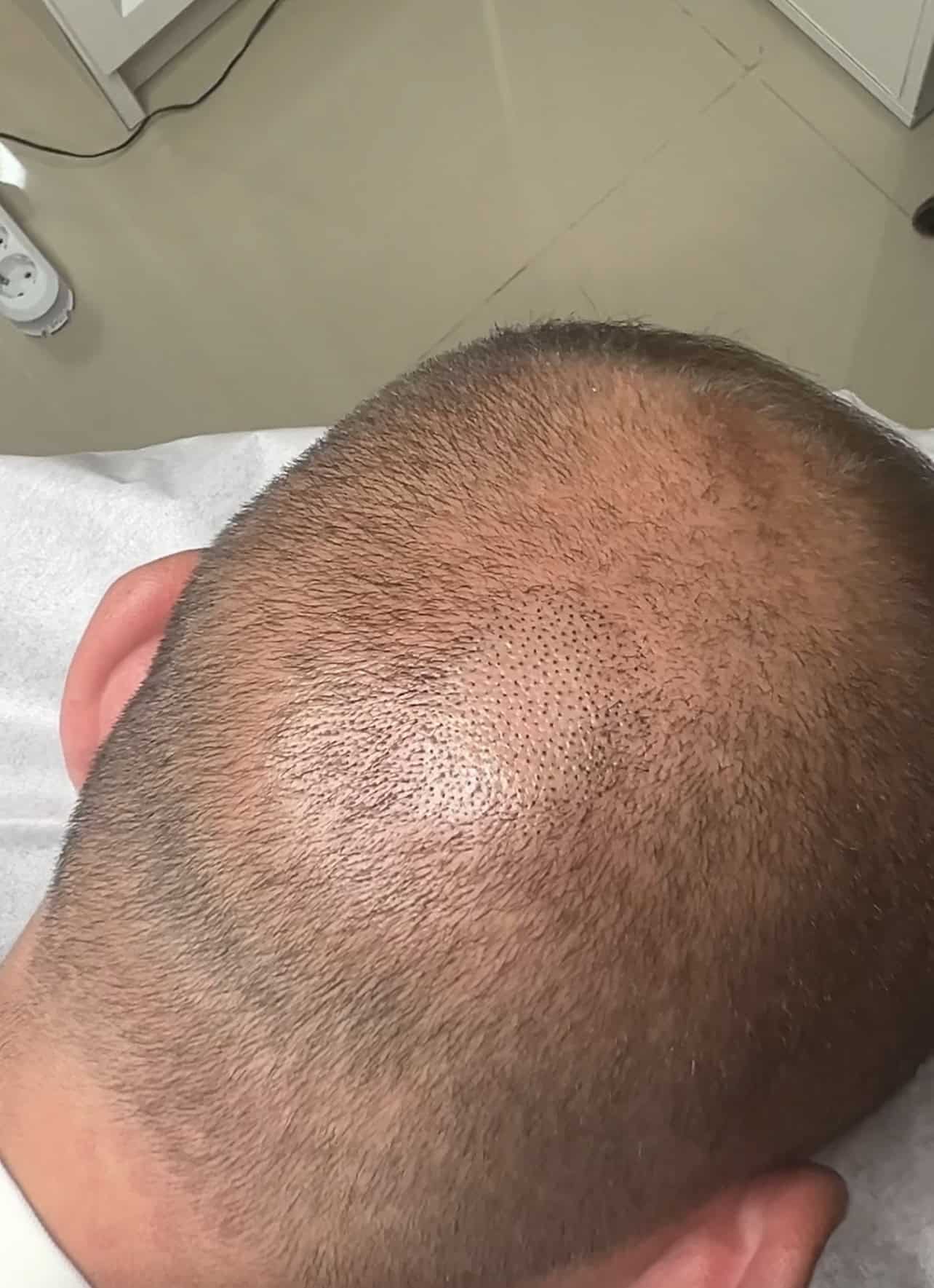 După SMP alopecie localizată — ScalpMicroArt Constanța