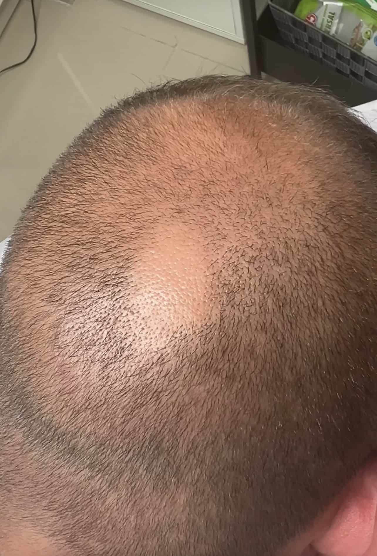 Înainte SMP alopecie localizată — ScalpMicroArt Constanța
